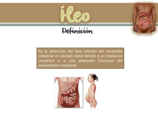 Es la detención del libre tránsito del contenido
intestinal en sentido distal debido a un obstáculo
mecánico o a una alteración funcional del
peristaltismo intestinal.
Definición
 