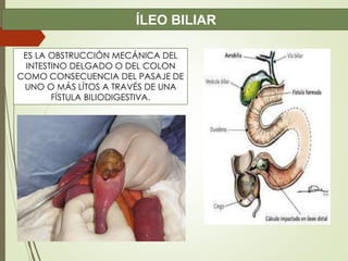 Ileo Biliar PPTX ileo-biliar-pptx