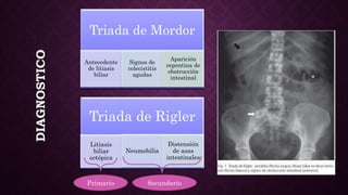 Sdinal De Rigler ILEO BILIAR.pptx . | PPTX