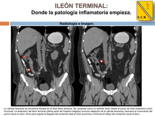 Ileon Netboot Anatomía Del íleon Terminal A) Segmento Intestino Delgado Con
