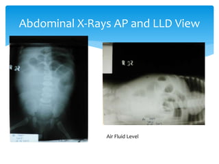 Abdominal X-Rays AP and LLD View
Air Fluid Level
 