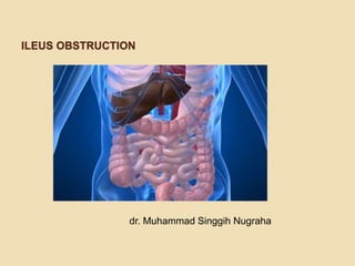 ILEUS OBSTRUCTION
dr. Muhammad Singgih Nugraha
 