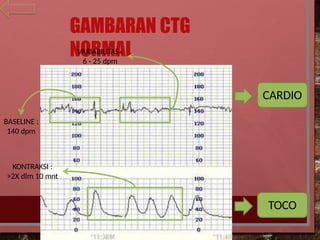 ilide.info-cardiotocography-pr_b70fe5cc85945093e71b0a1e3a3d1c6f.pptx
