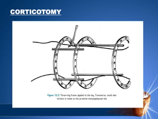 CORTICOTOMY
 