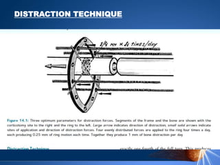 DISTRACTION TECHNIQUE
 