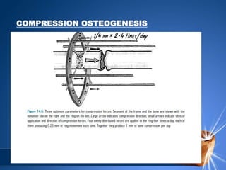 COMPRESSION OSTEOGENESIS
 