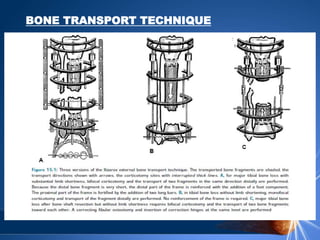 BONE TRANSPORT TECHNIQUE
 