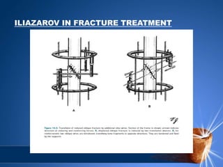 ILIAZAROV IN FRACTURE TREATMENT
 