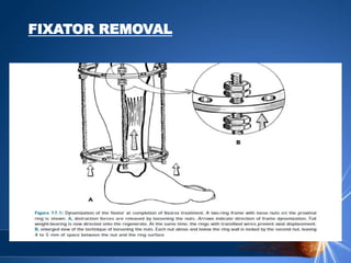 FIXATOR REMOVAL
 