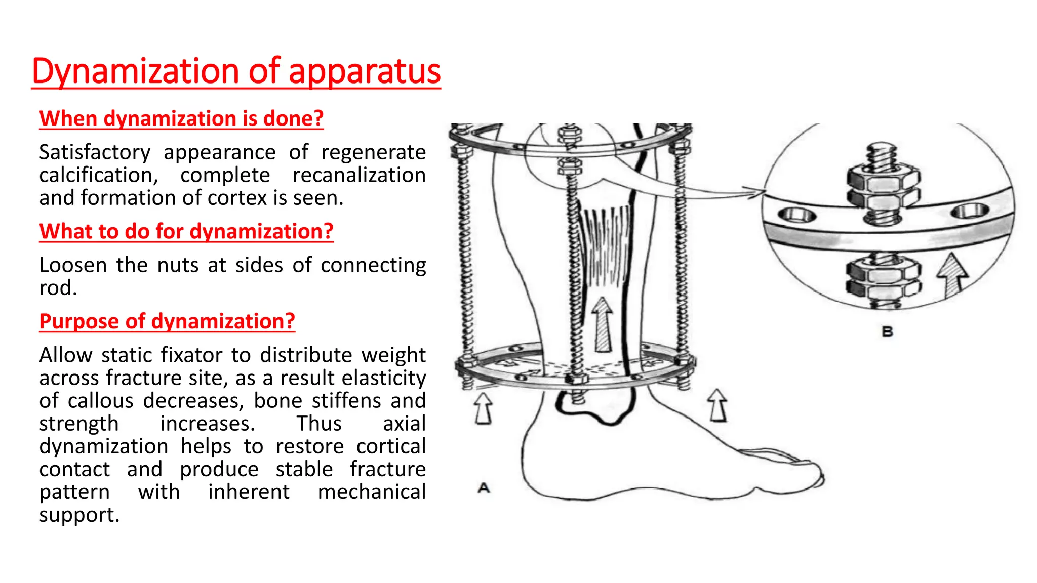 Dynamization ILIZAROV EXTERNAL FIXATOR | PPTX