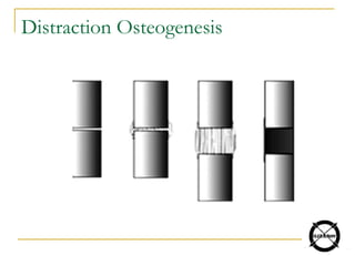Distraction Osteogenesis
 