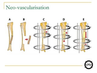 Neo-vascularisation
 
