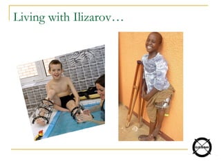 Living with Ilizarov…
 