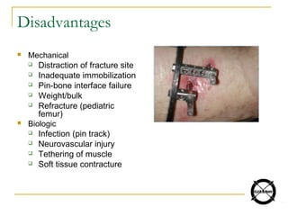 Disadvantages
 Mechanical
 Distraction of fracture site
 Inadequate immobilization
 Pin-bone interface failure
 Weight/bulk
 Refracture (pediatric
femur)
 Biologic
 Infection (pin track)
 Neurovascular injury
 Tethering of muscle
 Soft tissue contracture
 