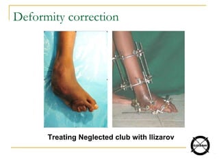 Deformity correction
Treating Neglected club with Ilizarov
 