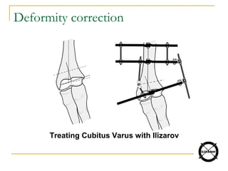 Deformity correction
Treating Cubitus Varus with Ilizarov
 
