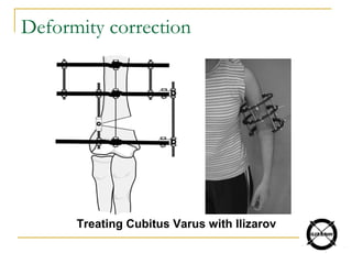 Deformity correction
Treating Cubitus Varus with Ilizarov
 