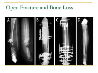 Open Fracture and Bone Loss
 