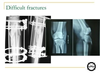 Difficult fractures
 