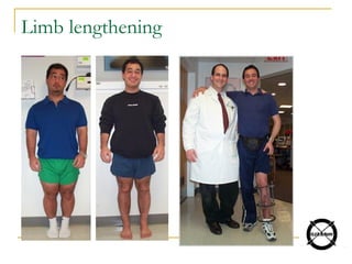 Limb lengthening
 