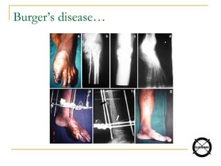 Burger’s disease…
 