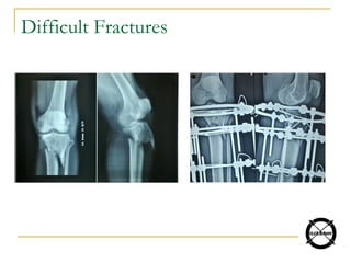 Difficult Fractures
 