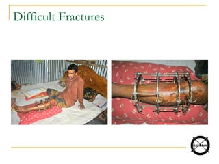 Difficult Fractures
 