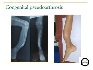 Congenital pseudoarthrosis
 