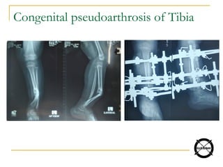 Congenital pseudoarthrosis of Tibia
 