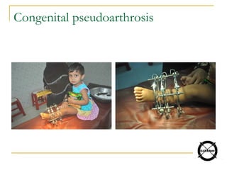 Congenital pseudoarthrosis
 