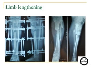 Limb lengthening
 