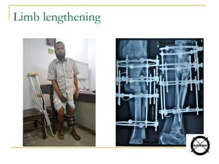 Limb lengthening
 