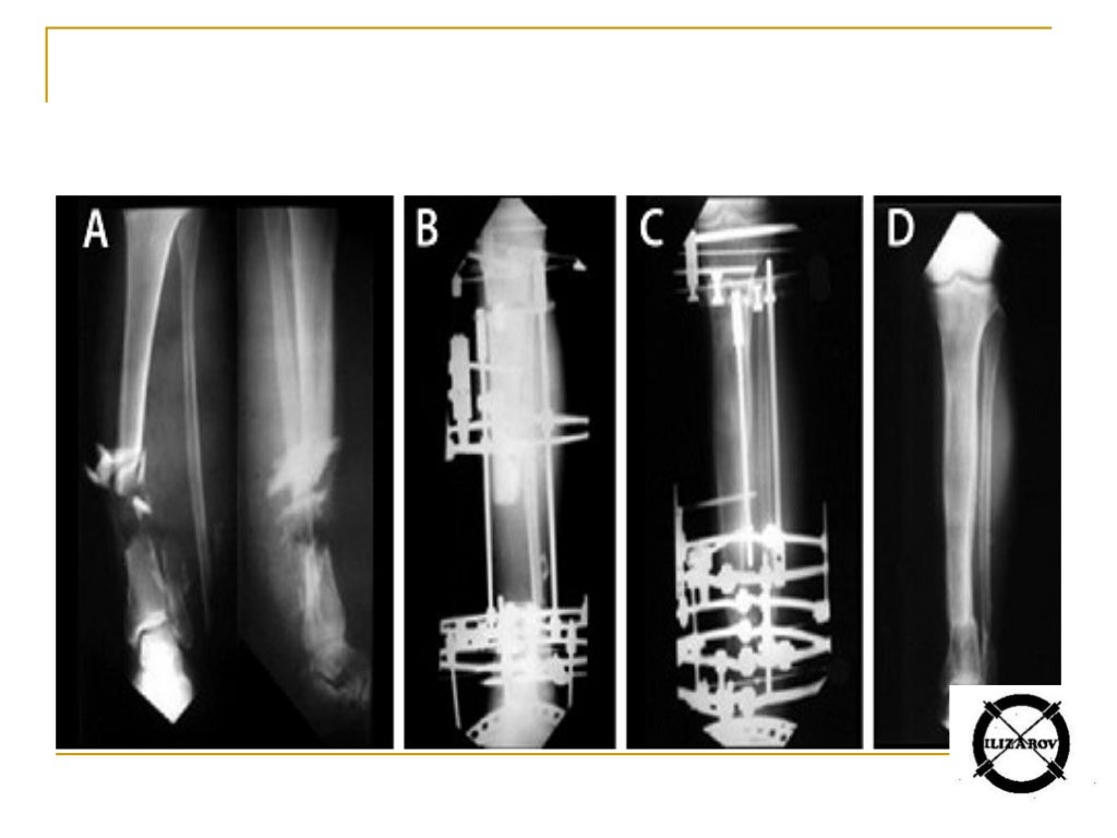 Ilizarov External fixator