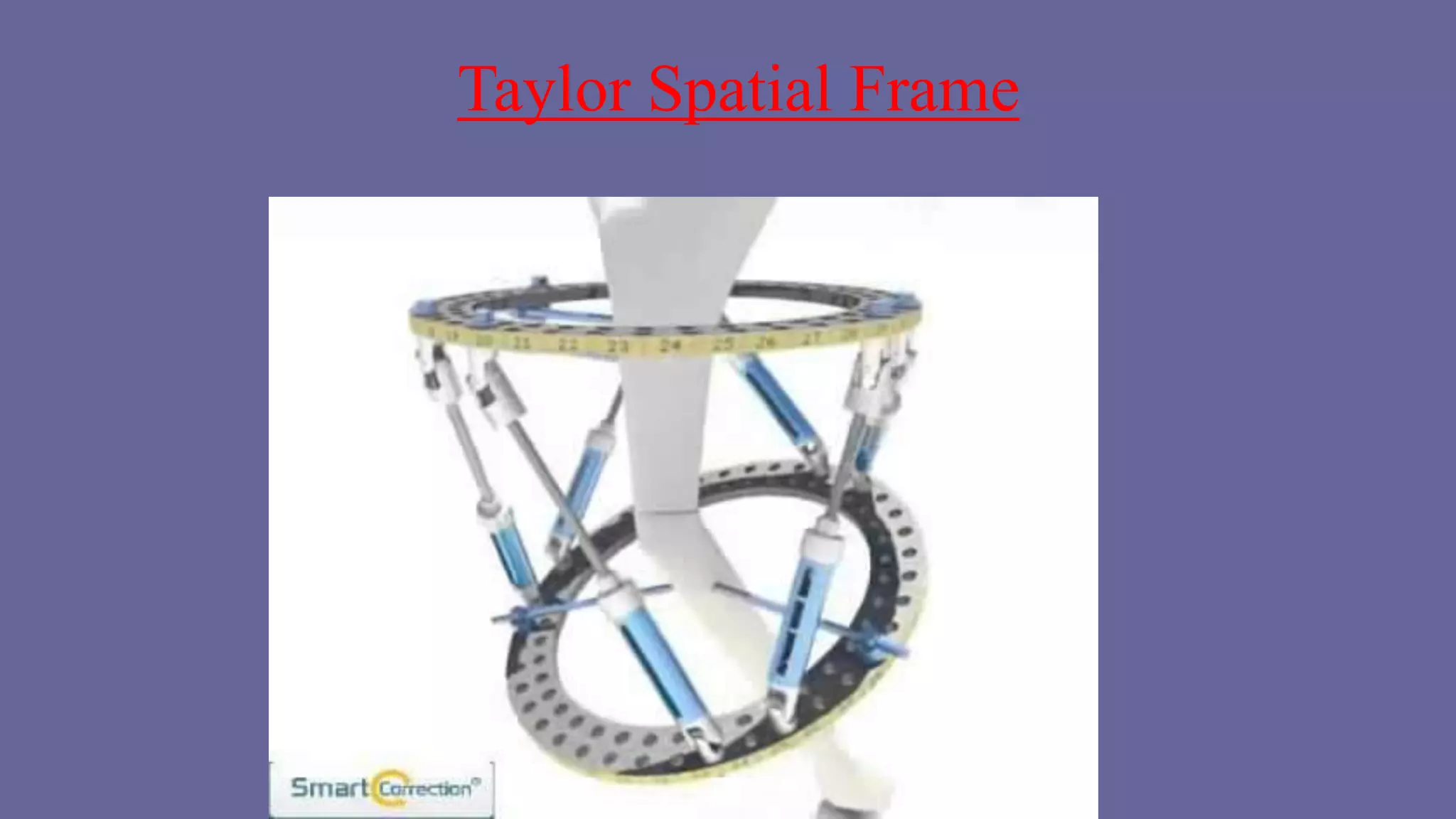 Ilizarov external fixator | PPTX