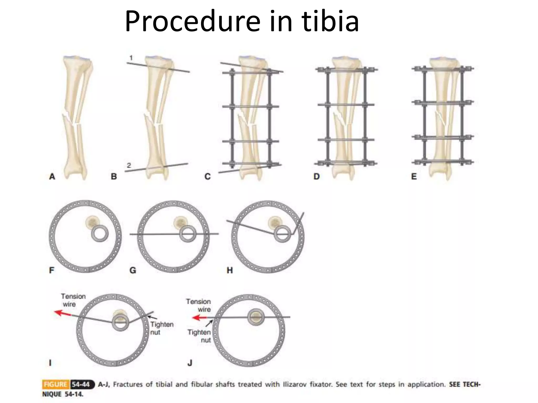 Procedure in tibia
 