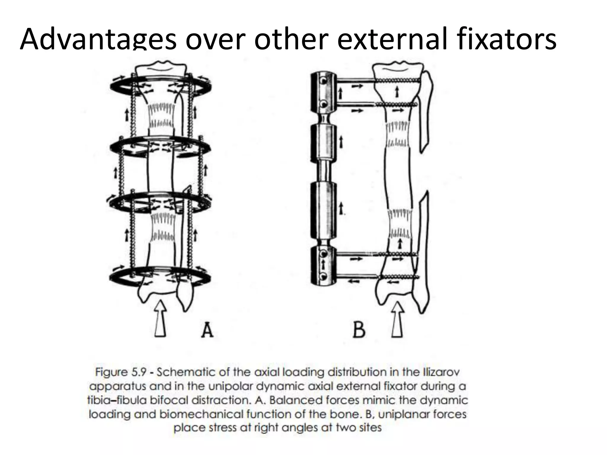 Advantages over other external fixators
 