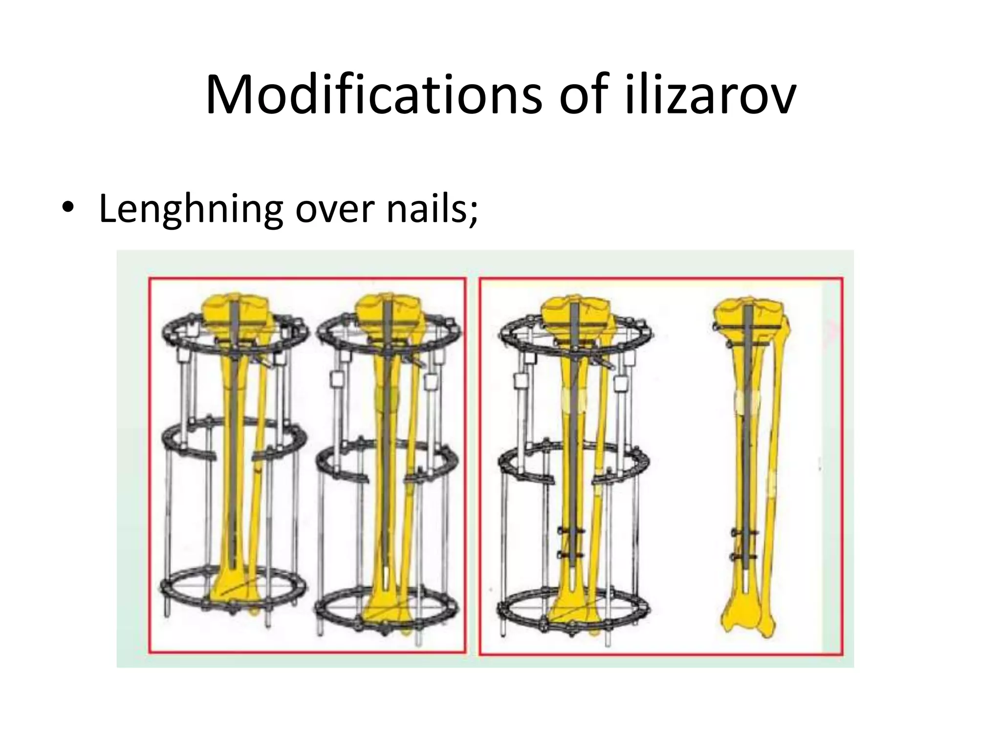 Modifications of ilizarov
• Lenghning over nails;
 