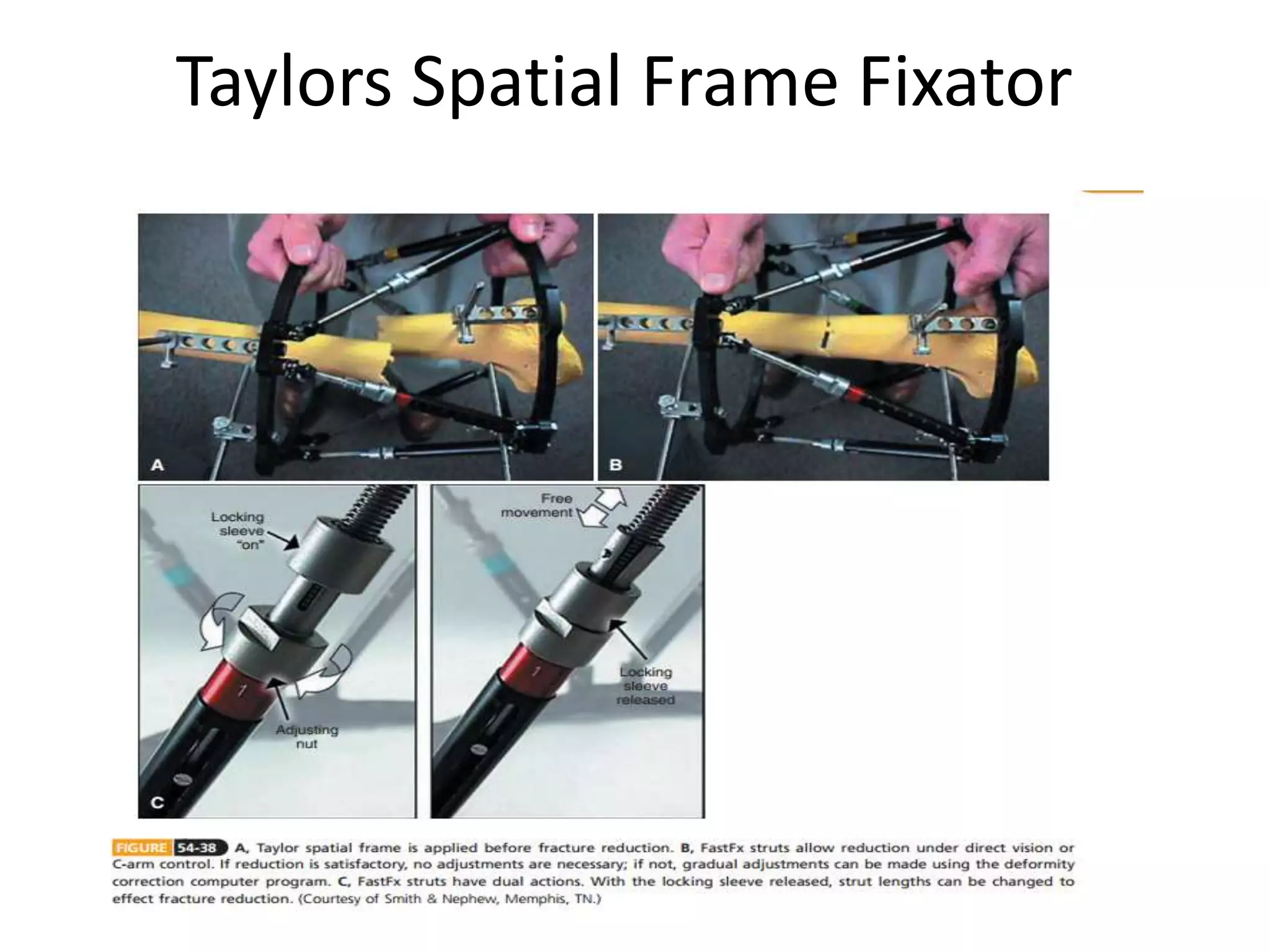 Taylors Spatial Frame Fixator
 