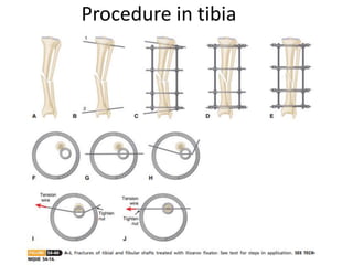 Procedure in tibia
 