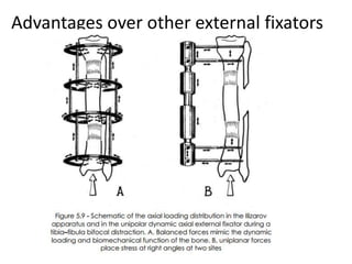 Advantages over other external fixators
 
