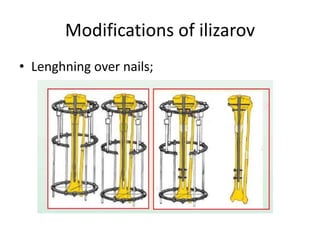Modifications of ilizarov
• Lenghning over nails;
 