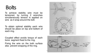 Bolts
To achieve stability wire must be
tensioned, by turning 2 wrenches
simultaneously tension is applied on
wire as it wrap around the bolt.
To obtain optimal stability each wire
should be place on top and bottom of
each ring.
Coupled effect avoids torque of each
bone segment fixed to the ring.
Fixing the wire on the both surface
also prevent wrapping of the ring.
DPS
 