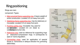 Ringpositioning
Rings are main
component Types-
 Main proximal frame supporting ring- it bears weight of
entire construction. Located 3-5 cm away from joint.
 Stabilizing frame supporting ring- may be stationary or
moveable. Located 3-5 cm away from joint.
 Pushing pulling ring- moveable ring used for
compressionor distraction. Located 3-5 cm distal to
fracture-osteotomy-nonunion site.
 Reference ring- used as reference for supporting rings
or distraction-compression rings. It corresponds to
apex of bone angulation.
 Connecting rings- used for application of special
forces in transverse or oblique direction for correcting
deformities. DPS
 
