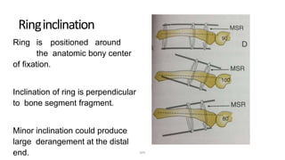 Ringinclination
Ring is positioned around
the anatomic bony center
of fixation.
Inclination of ring is perpendicular
to bone segment fragment.
Minor inclination could produce
large derangement at the distal
end. DPS
 