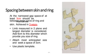 Spacingbetweenskinandring
At the narrowest gap space of at
least 3cm should be
maintainedbetween inner curve of ring and
skin. Achieved in 3 ways-
• Limb measured in 2 plane and
largest diameter is considered.
Add 6cm to this diameter which
provide you size of ring.
• Attach most anticipated size
and seek a space of 3cm.
• Use plastic template.
DPS
 