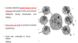 • Loosely attached slotted fixation bolt at
entrance site guide K-wire and prevent
deflection during introduction and
drilling.
• One wire one hole to prevent incorrect
positioning.
• Push wire manually to bone
before
drilling.
DPS
 