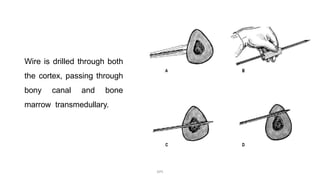 Wire is drilled through both
the cortex, passing through
bony canal and bone
marrow transmedullary.
DPS
 