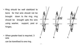 • Ring should be well stabilized to
bone for that wire should not be
brought down to the ring, ring
should be brought upto the wire
using washer, support, post or
hinges.
• When greater load is required, 3
wire
can be transfixed to one ring.
DPS
 