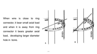 When wire is close to ring
connector, it bear small axial load
and when it is away from ring
connector it bears greater axial
load, developing larger diameter
hole in bone.
DPS
 