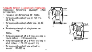 Adequate tension is paramount importance.
Inadequate tensioning adversely effect
development.
• Range of wire tensioning- 50- 130kg.
• Tensioning strength of wire on half ring-
50-70 kg.
• Tensioning strength of offsite wire- 50-80
kg.
• Tensioning strength of single wire on
ring-
100kg.
• Tensioningstrength of 2-3 wires on ring in
young patient – 110 kg each ring.
• Tensioningstrength of 2-3 wires on ring in
adult patient – 120-130 kg each ring
• Tensioning strength of wire with olive
stopper- 100-110 kg.
DPS
 